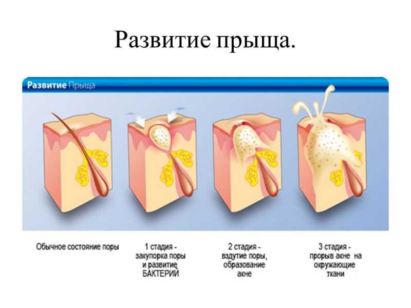 К чему снятся чирьи на теле. фурункул толкование сонника - первый астрологический
