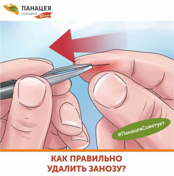 К чему снится заноза в руке, в ноге, в ладони? полная трактовка сновидения