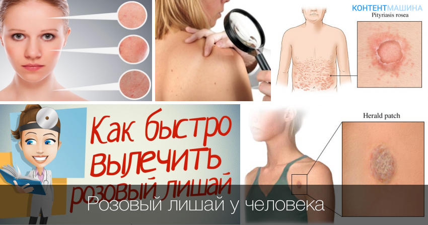 К чему снится лишай?