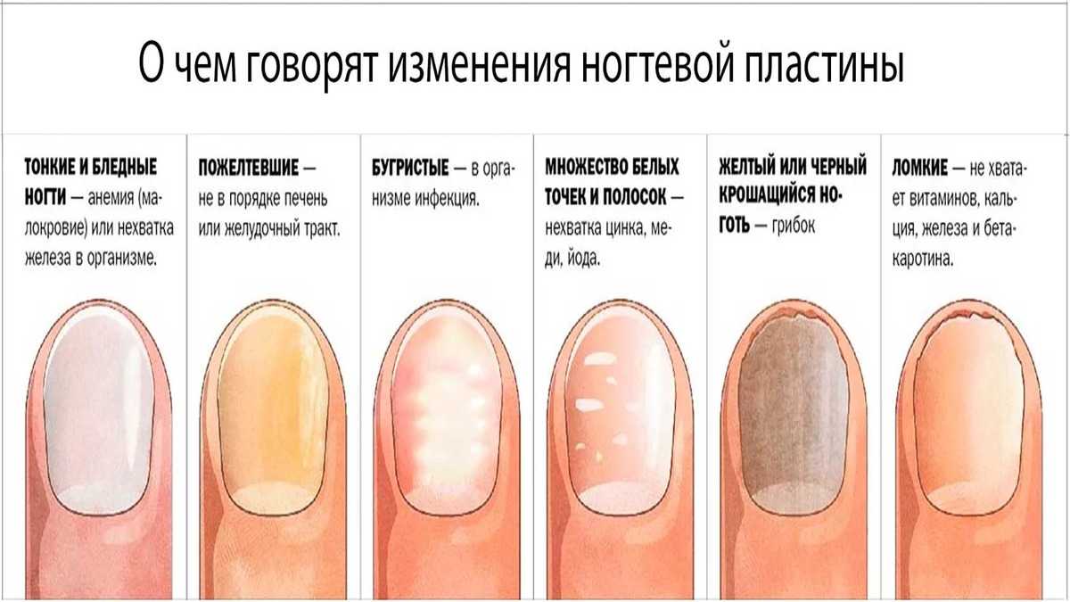 Значение пятен на ногтях