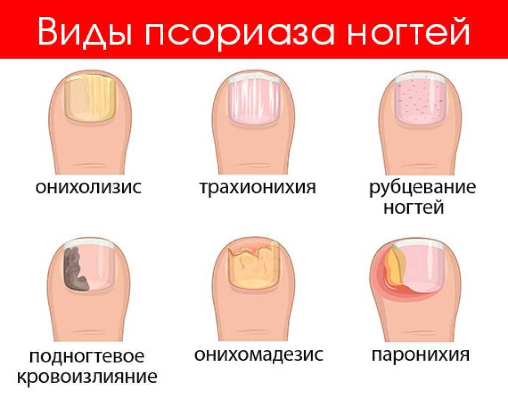 Что значат белые пятна на ногтях – приметы