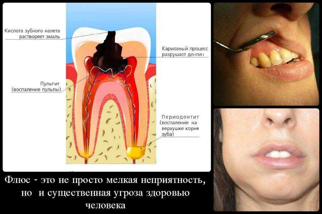 К чему снится лопнувший флюс