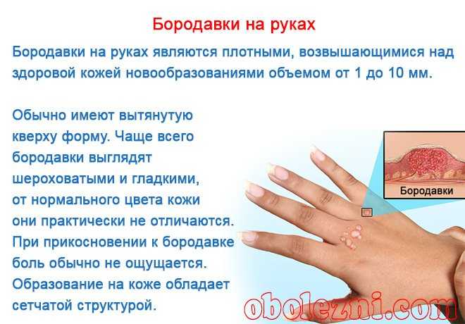 К чему снится бородавка - значение сна бородавка по соннику