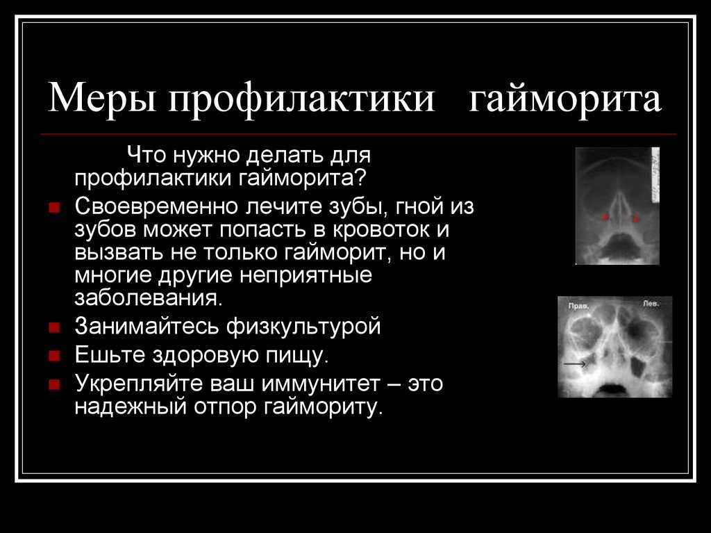 Заговор от гайморита и других простудных заболеваний