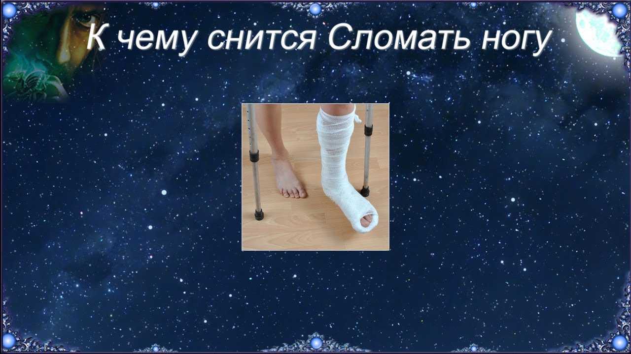 К чему снится сломанная нога 💤 - 40 точных значений сна ❗ по сонникам: что означает, если приснился открытый или закрытый перелом у себя или у другого человека