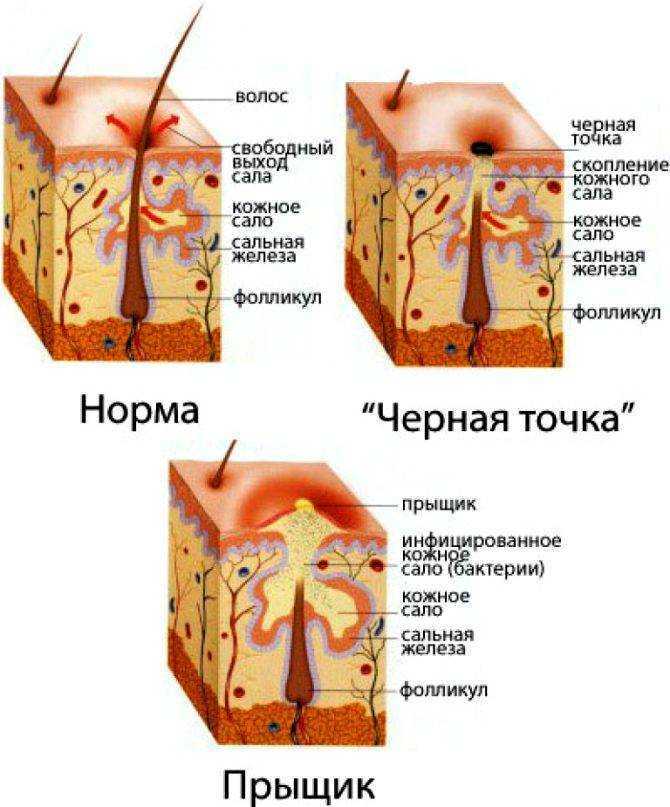 К чему снится выдавливать прыщи у себя на теле