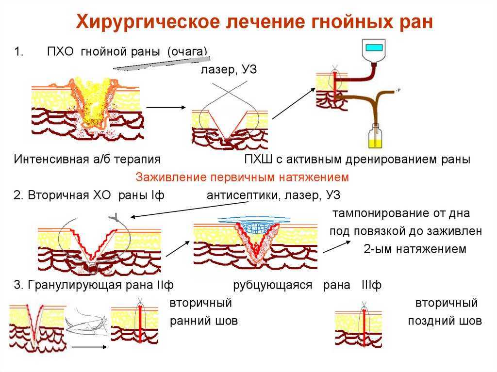 К чему снится гной - значение сна гной по соннику